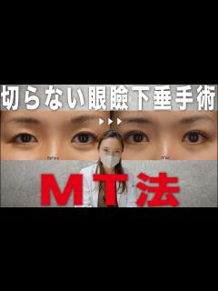 [x]【よくわかる MT法 症例解説】切らない眼瞼下垂手術 BIANCA CLINIC - YouTube