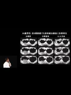 [x]肺がんの放射線治療 永田靖 - YouTube