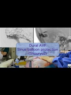 [x]硬膜動静脈瘻ONYX塞栓 サイナスバルン (Shouryu2) Dural AVF sinus balloon protection ...